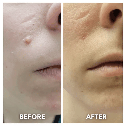 Electronic Acne Patches